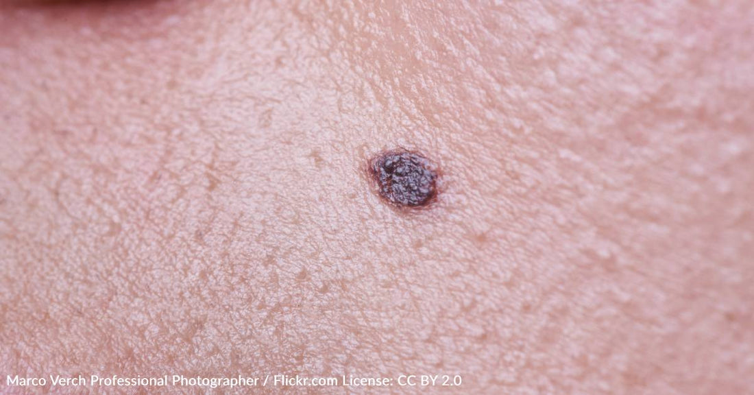 Signs Of Skin Cancer To Watch Out For After Fun In The Sun